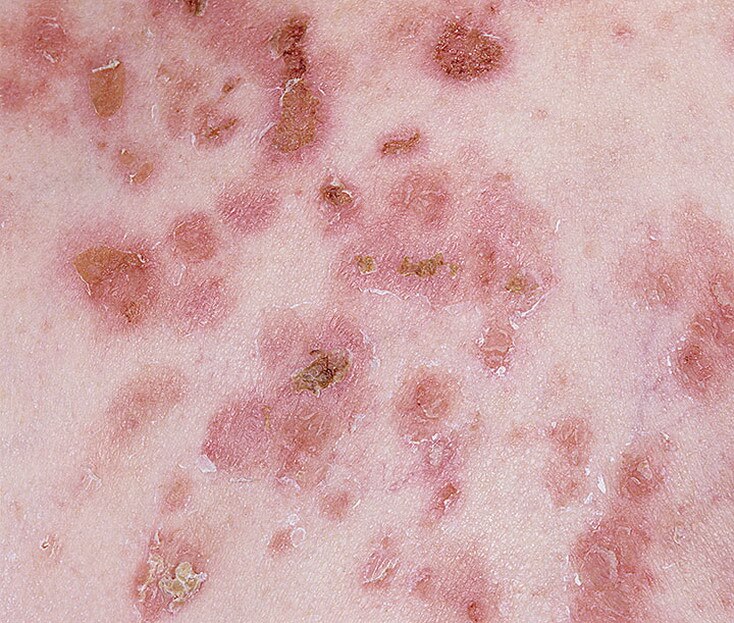 pemphigus-foliaceous-12-a-foto