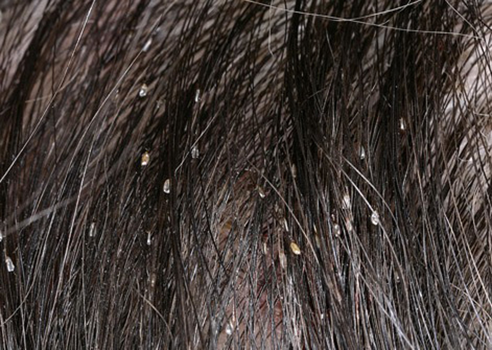 pidocchi-metodo-ostia-roma