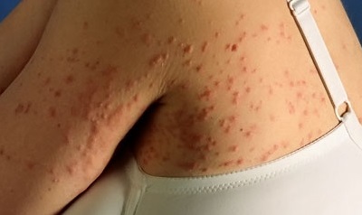 Что такое почесуха: симптомы и лечение