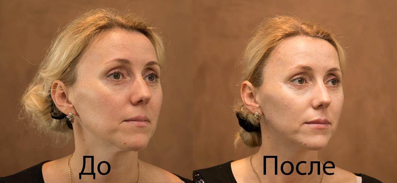 premium-revitalizatsiya-flosal