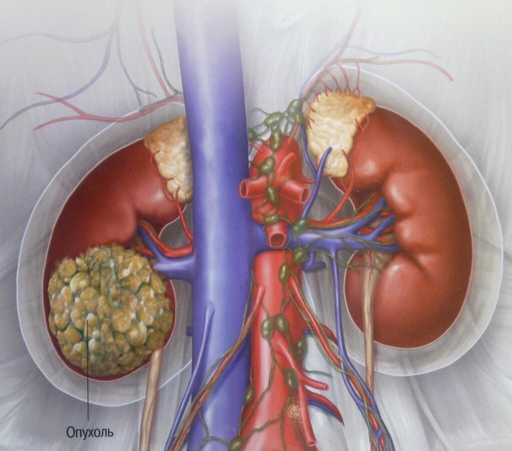 prichiny_raka_pochek