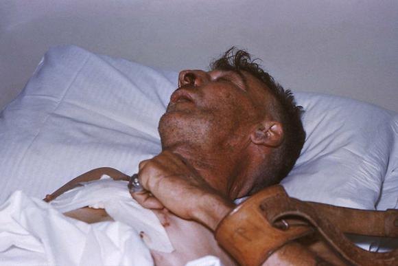 Паралитическая стадия