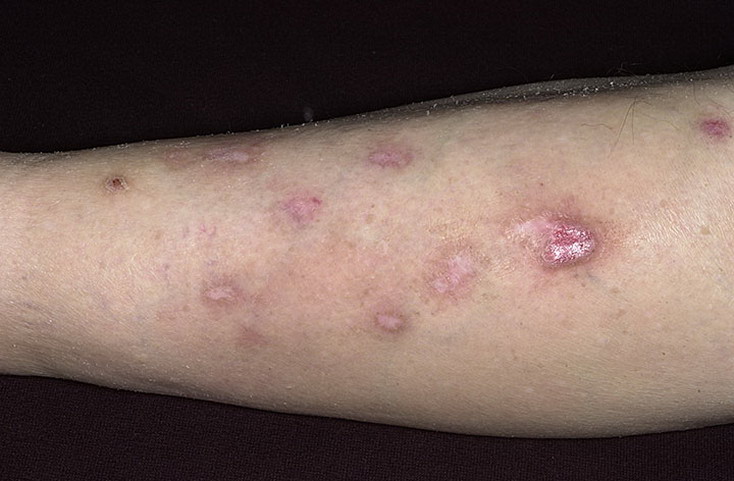 prurigo-uzlovoe_42-a-foto