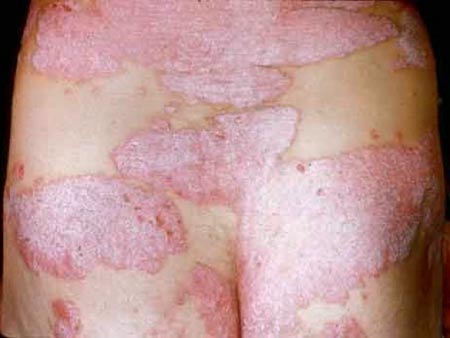 psoriasis