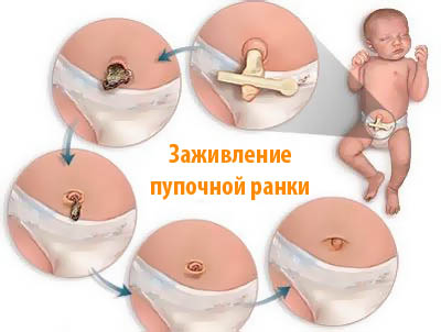 Пупочная ранка