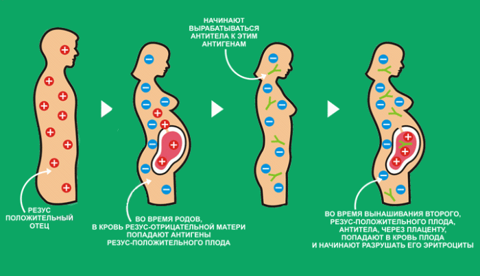 rezus_konflikt_pri_beremennosti