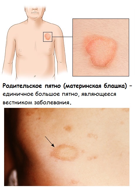 Симптомы розового лишая