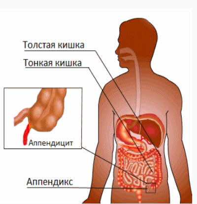 s-kakoy-storony-appenditsit-foto1
