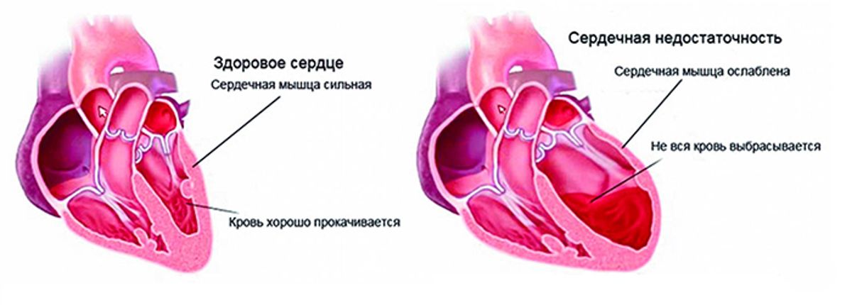 serdechnaya_nedostatochnost
