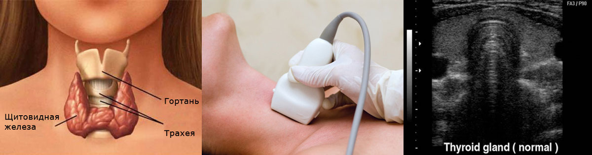 Симптомы кисты щитовидной железы