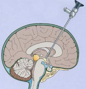 водянки головного мозга новорожденных