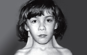 simptom_shereshevskogo_ternera