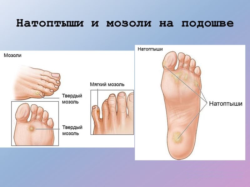 Разновидности мозолей