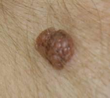 Сложный невус