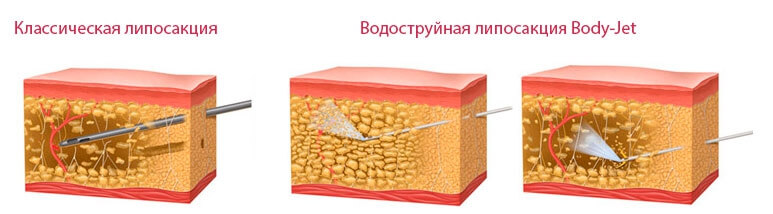 sravnenie-body-jet