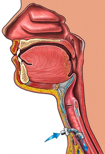 tracheostomy-tube