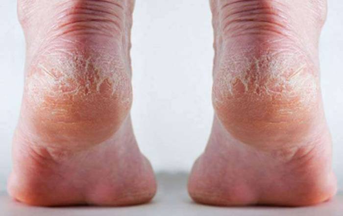 tri-prostyh-sposoba-zabyt-o-treschinah-na-pyatkah_1