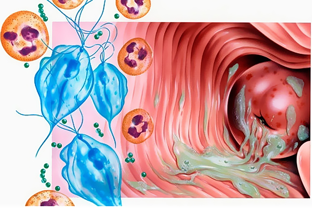 Симптомы трихомониаза у женщин