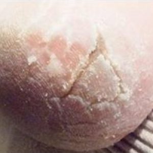 uslugi-lechenie-giperkeratoza