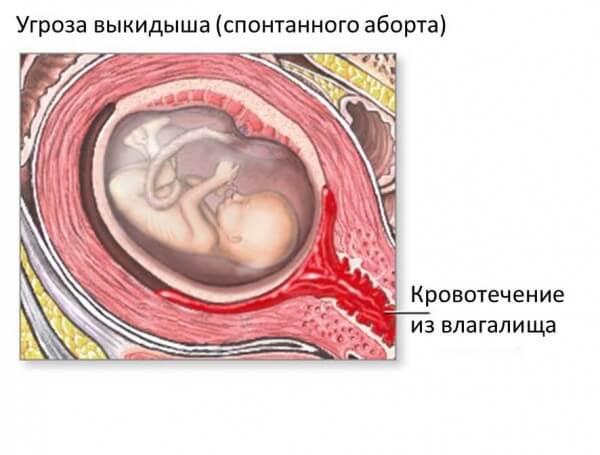 vikidish-ns-rannix-srokax