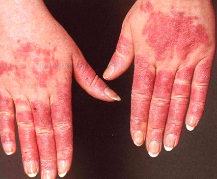 Кожные покровы