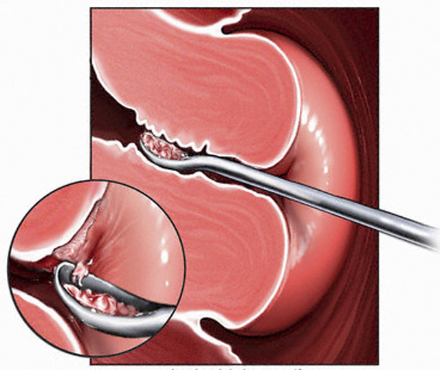 Диагностическое выскабливание и лапароскопия