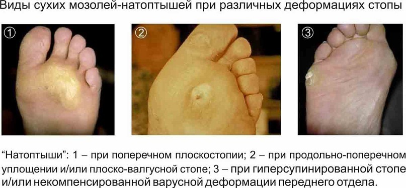 Виды мозолей