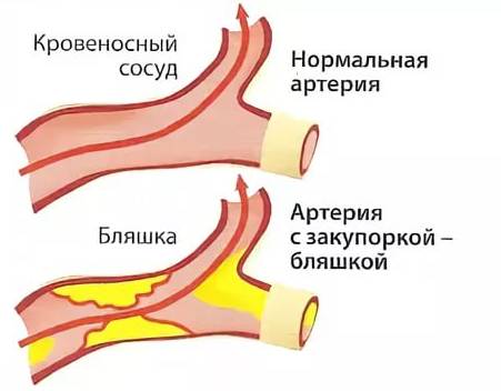 Артерия с закупоркой Артерия с закупоркой