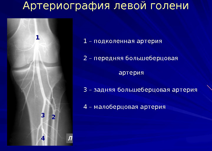 Артериография левой голени Артериография левой голени