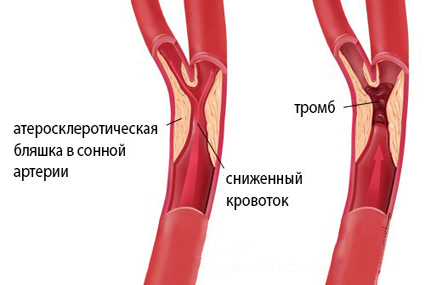 Атеросклеротическая бляшка и тромб Атеросклеротическая бляшка и тромб
