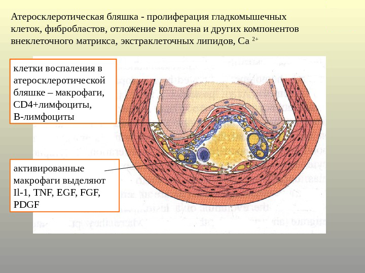 Атеросклеротическая бляшка Атеросклеротическая бляшка
