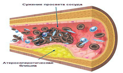 Атеросклеротические бляшки в сосудах Атеросклеротические бляшки в сосудах