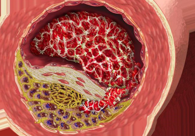Атеросклеротическое поражение артерий Атеросклеротическое поражение артерий