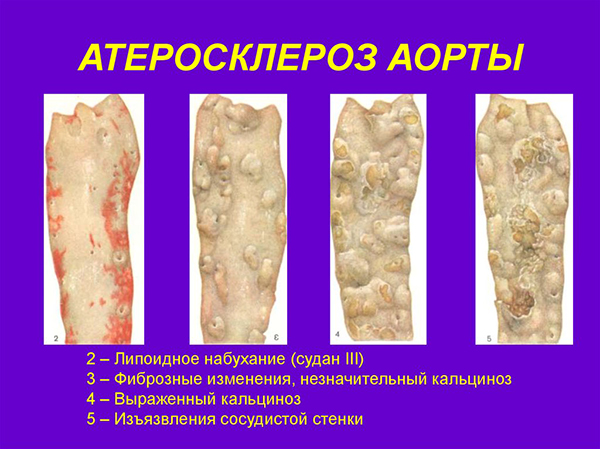 Атеросклероз аорты Атеросклероз аорты