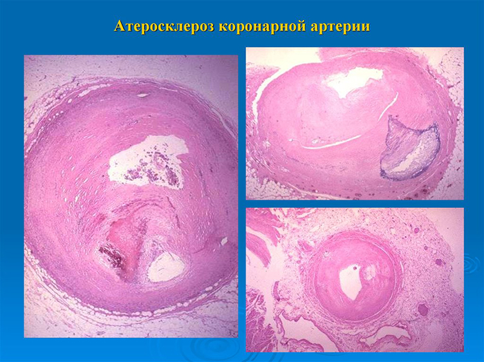Атеросклероз коронарной артерии Атеросклероз коронарной артерии