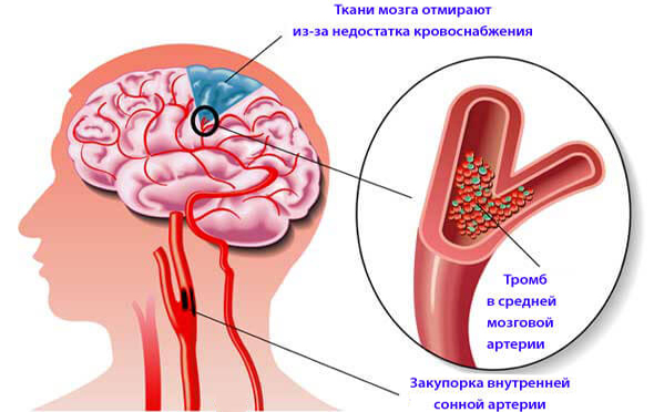 Атеросклероз сосудов головного мозга Атеросклероз сосудов головного мозга