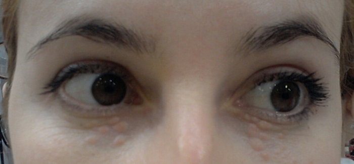 Бляшки под глазами Бляшки под глазами