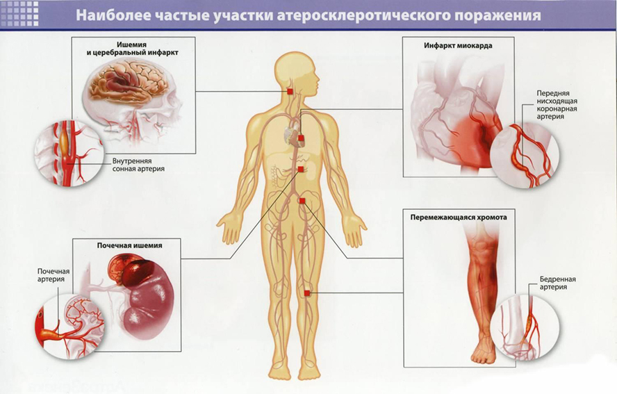 Частые участки атеросклеротического поражения Частые участки атеросклеротического поражения