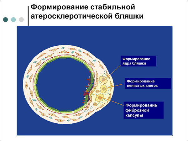 Формирование стабильной атеросклеротической бляшки Формирование стабильной атеросклеротической бляшки