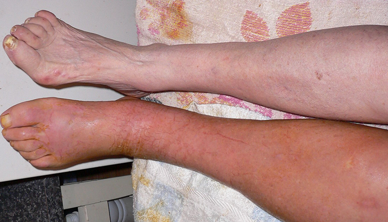 Фото атеросклероза сосудов ног Фото атеросклероза сосудов ног