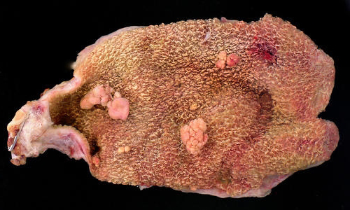 Фото холестериновых полипов Фото холестериновых полипов