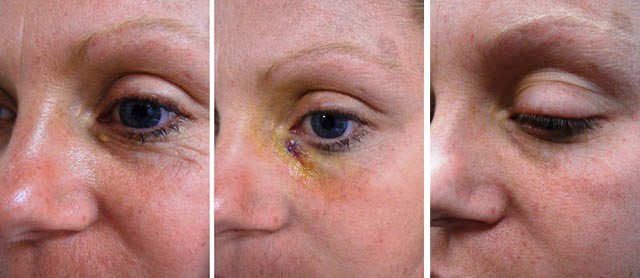 Хирургическое иссечение ксантом Хирургическое иссечение ксантом