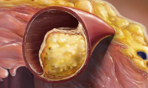 Холестериновые бляшки в сосудах Холестериновые бляшки в сосудах