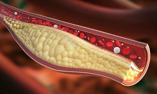 Холестериновые бляшки в сосудах Холестериновые бляшки в сосудах
