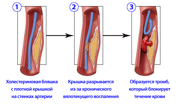 Инфаркт миокарда Инфаркт миокарда