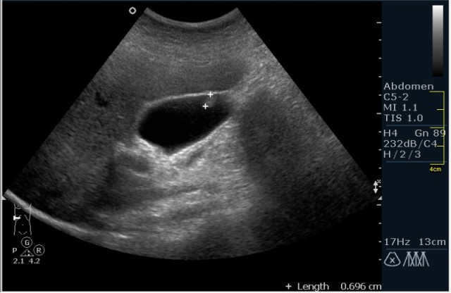 Эхографическая картина холестеринового полипа Эхографическая картина холестеринового полипа