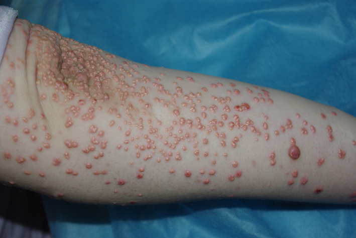 Эруптивные ксантомы Эруптивные ксантомы