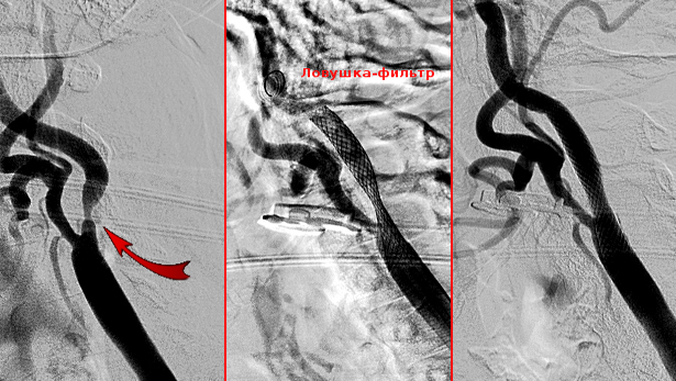 Этапы стенирования Этапы стенирования