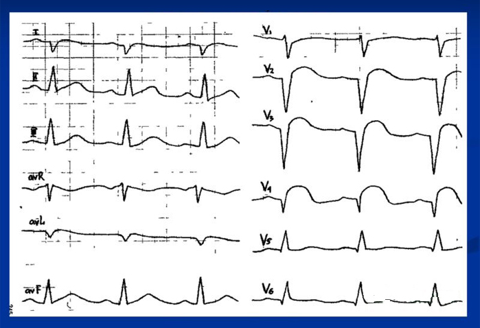 Кардиограмма при кардиосклерозе Кардиограмма при кардиосклерозе