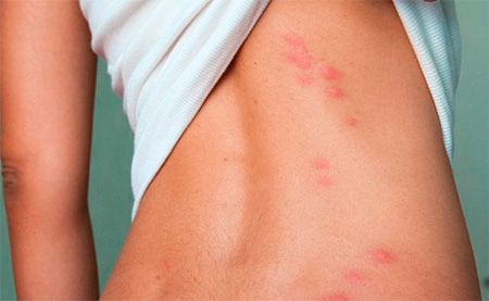 Кожная сыпь Кожная сыпь